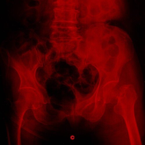 Impotence (3DISON5 Phonk Remix) cover art