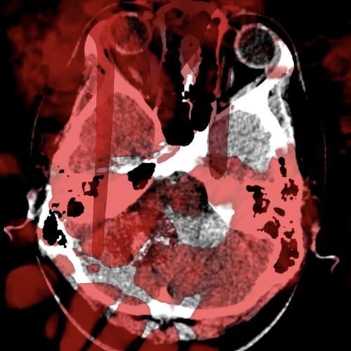 Cavernoma cover art